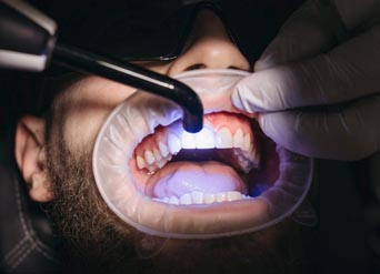 4 Benefits of Professional Teeth Whitening | Moreno Valley